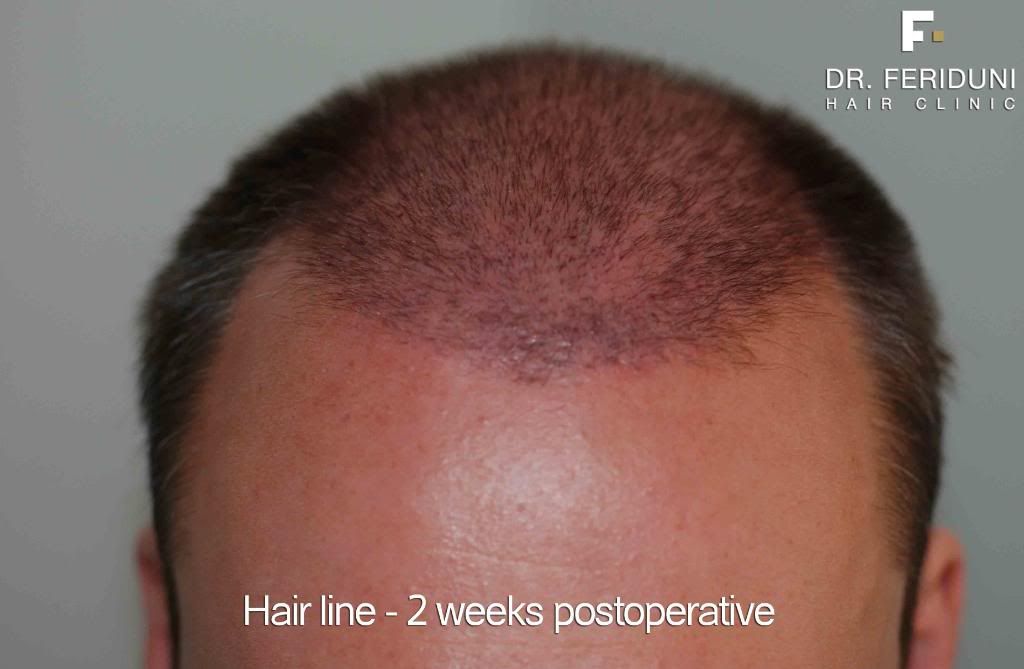 Hair loss, hair transplant and hair restoration advice